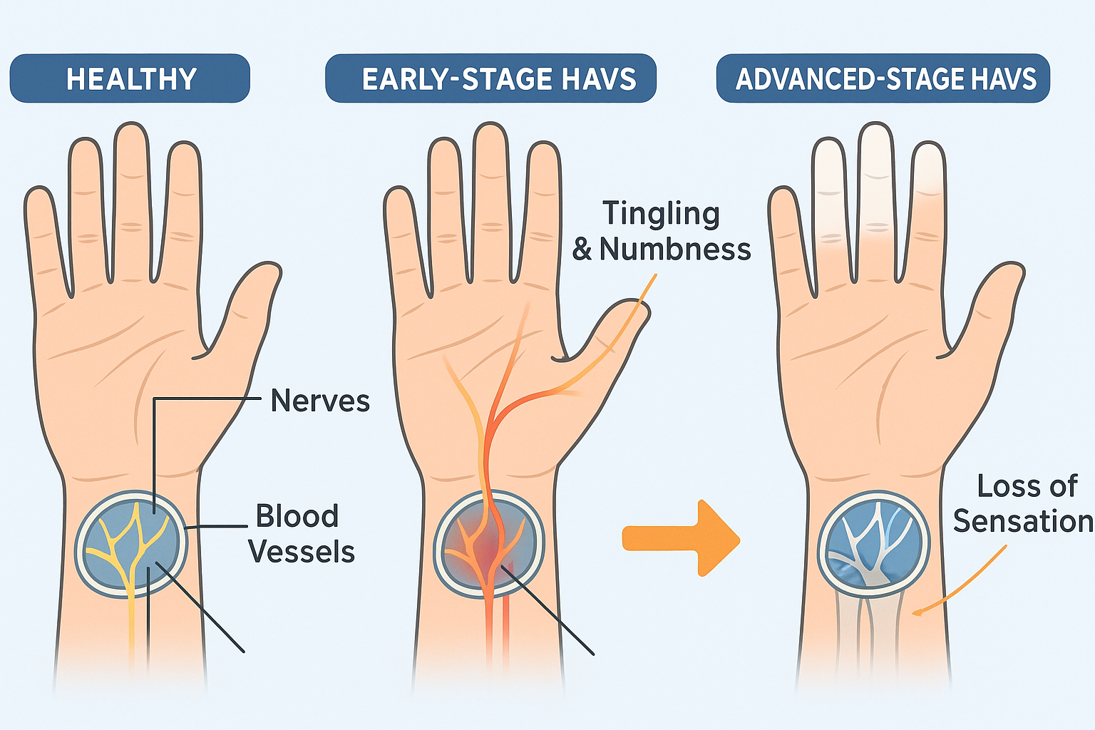 Medical diagram showing the progression of Hand-Arm Vibration Syndrome (HAVS) from a healthy hand to advanced stages